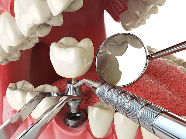 Best Emergency Dentist for Lost Fillings or Crowns in Fort Thomas, KY